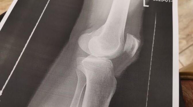 膝の診断